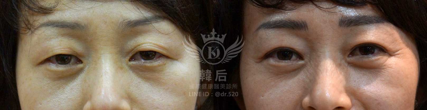 韓后醫美,雙眼皮重修,韓國,上海,台灣,整形修復專科,素人真實案例