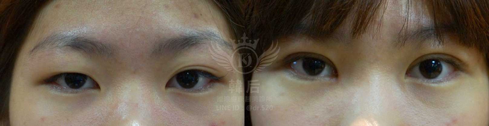 韓后醫美,雙眼皮重修,韓國,上海,台灣,整形修復專科,素人真實案例