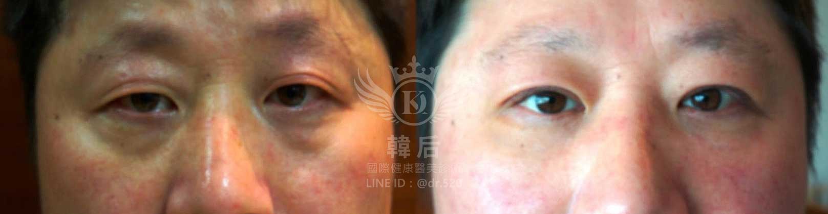 韓后醫美,雙眼皮重修,韓國,上海,台灣,整形修復專科,素人真實案例