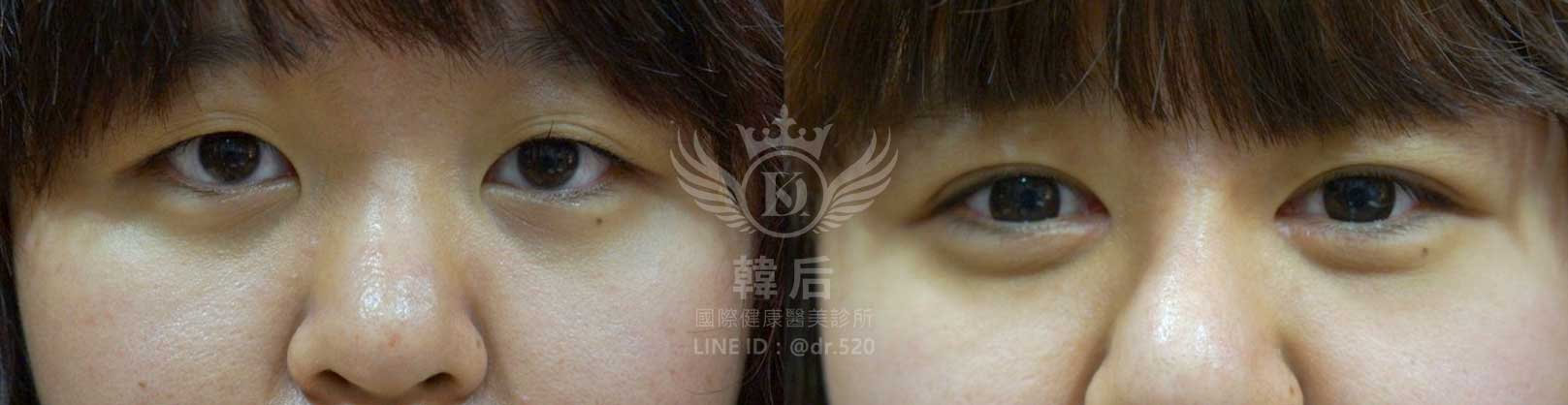 韓后醫美,韓式雙眼皮,無痕割雙眼皮,雙眼皮,素人真實案例
