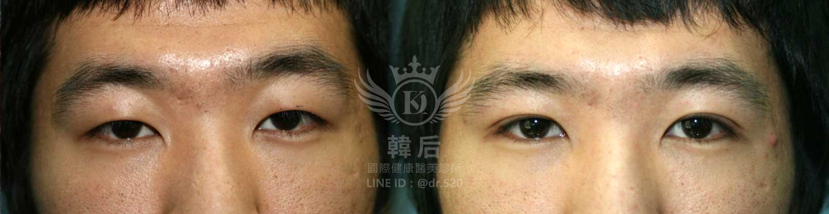 韓后醫美,韓式雙眼皮,無痕割雙眼皮,雙眼皮,素人真實案例