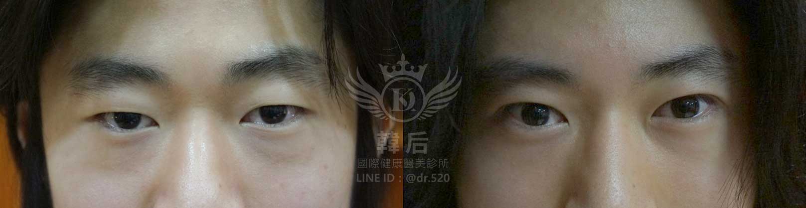 韓后醫美,韓式雙眼皮,無痕割雙眼皮,雙眼皮,素人真實案例