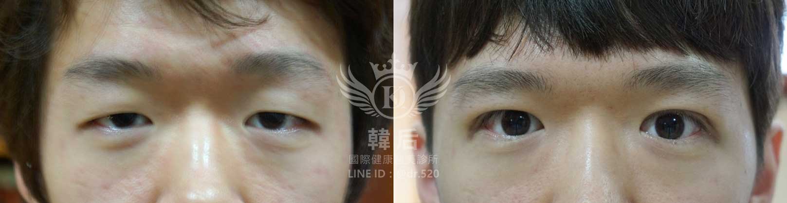 韓后醫美,韓式雙眼皮,無痕割雙眼皮,雙眼皮,素人真實案例