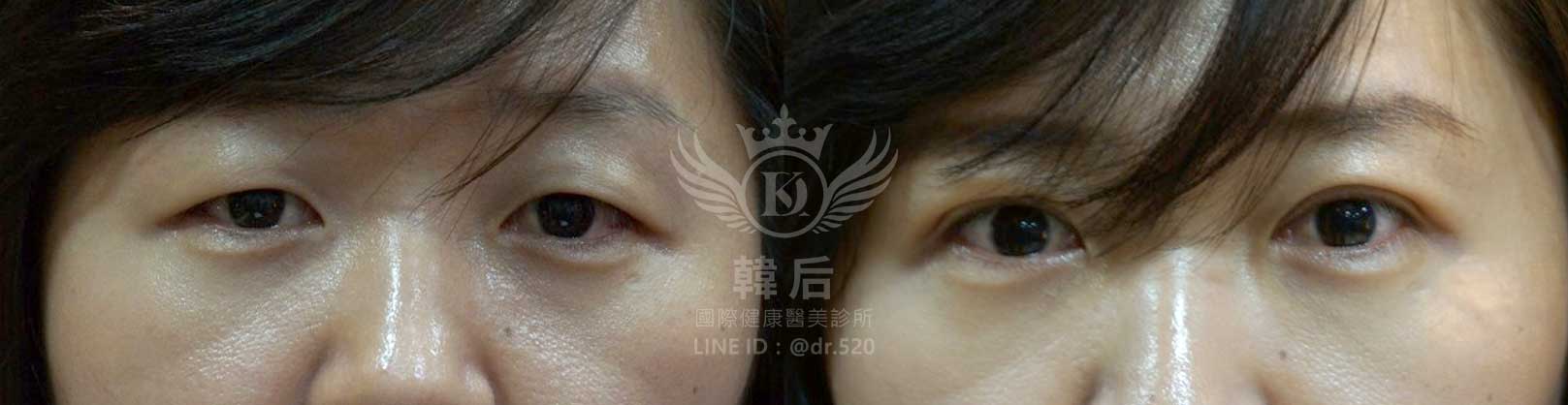 韓后醫美,韓式雙眼皮,無痕割雙眼皮,雙眼皮,素人真實案例