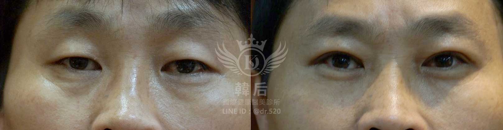 韓后醫美,韓式雙眼皮,無痕割雙眼皮,雙眼皮,素人真實案例
