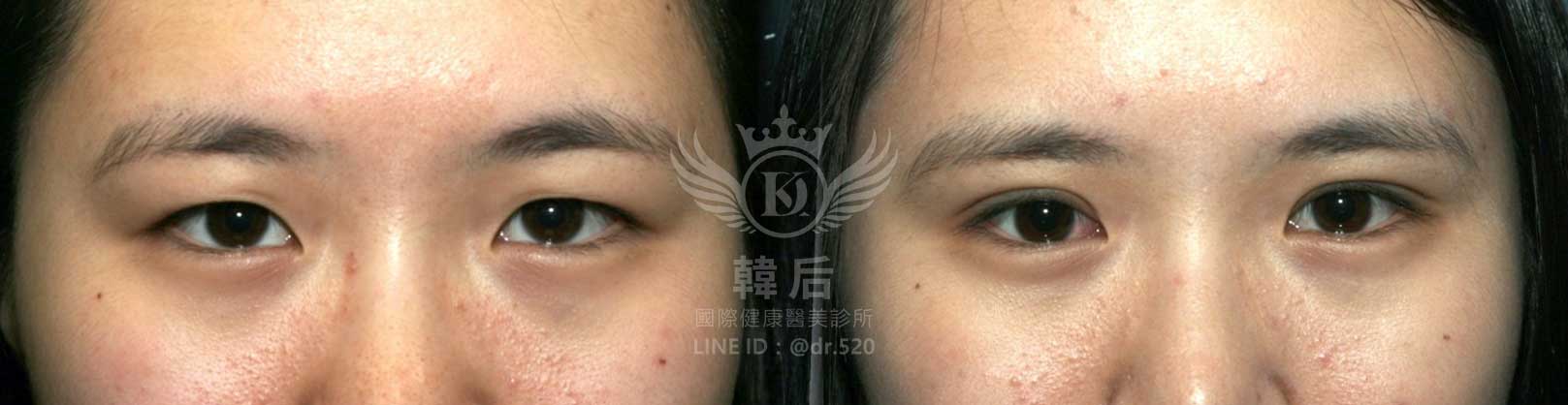韓后醫美,韓式雙眼皮,無痕割雙眼皮,雙眼皮,素人真實案例
