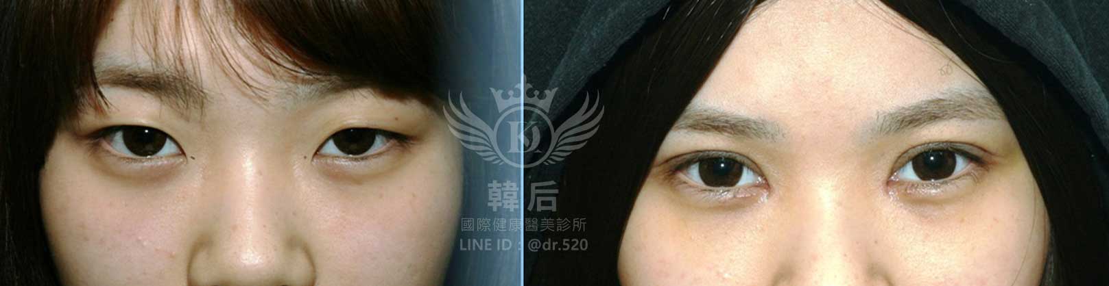 韓后醫美,韓式雙眼皮,無痕割雙眼皮,雙眼皮,素人真實案例