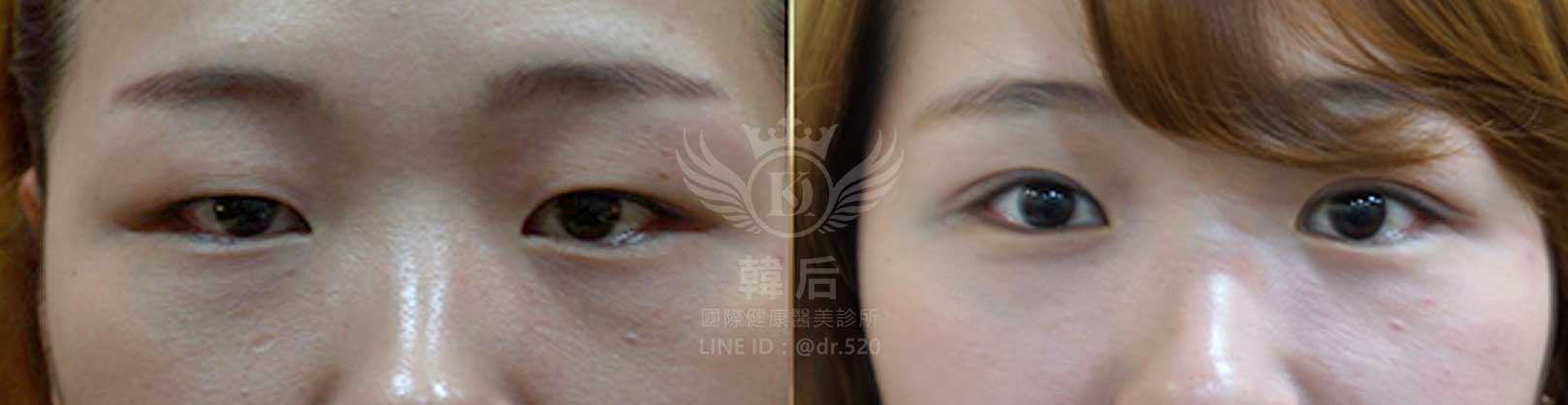 韓后醫美,韓式雙眼皮,無痕割雙眼皮,雙眼皮,素人真實案例