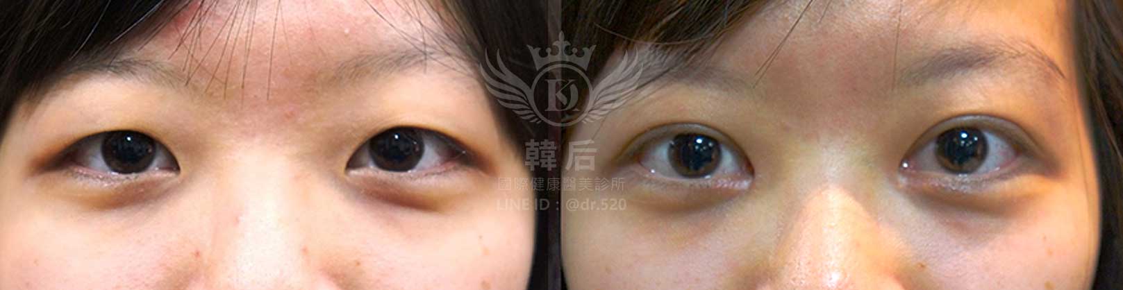 韓后醫美,韓式雙眼皮,無痕割雙眼皮,雙眼皮,素人真實案例