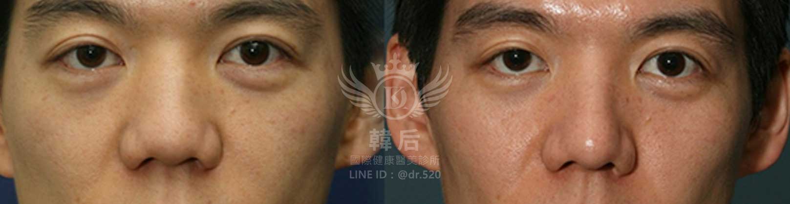 韓后醫美,隆鼻失敗重修,鼻部重修手術,素人真實案例