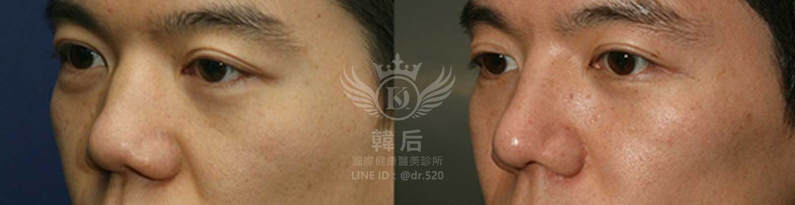 韓后醫美,隆鼻失敗重修,鼻部重修手術,素人真實案例