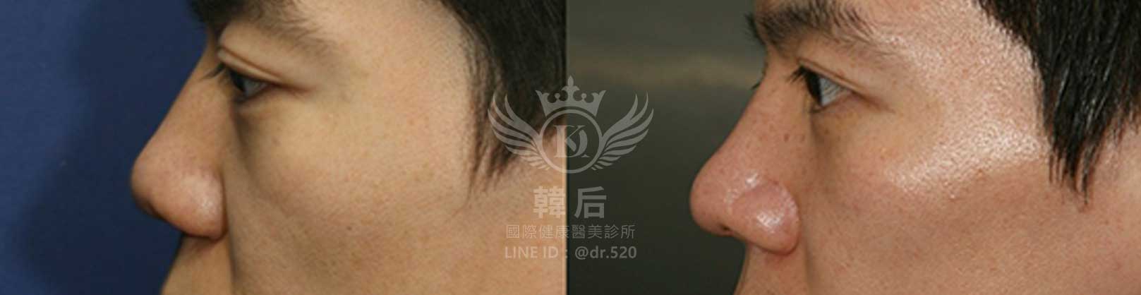 韓后醫美,隆鼻失敗重修,鼻部重修手術,素人真實案例