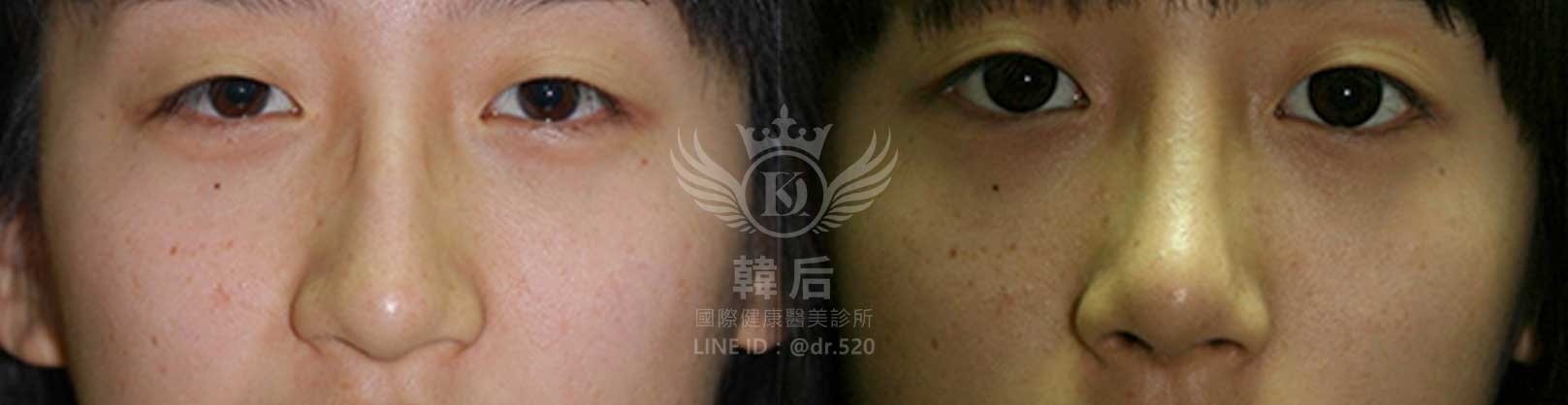 韓后醫美,隆鼻失敗重修,鼻部重修手術,素人真實案例
