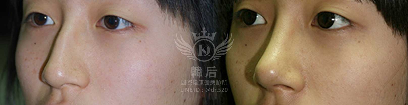 韓后醫美,隆鼻失敗重修,鼻部重修手術,素人真實案例