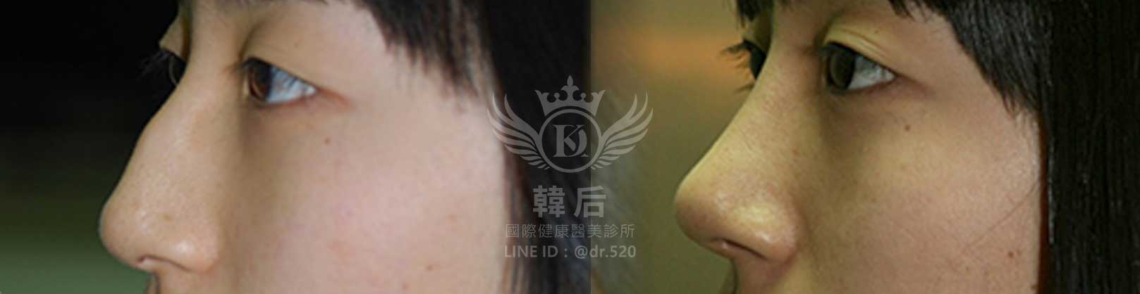 韓后醫美,隆鼻失敗重修,鼻部重修手術,素人真實案例