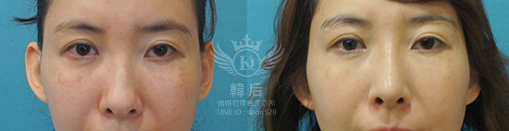 韓后醫美,隆鼻失敗重修,鼻部重修手術,素人真實案例