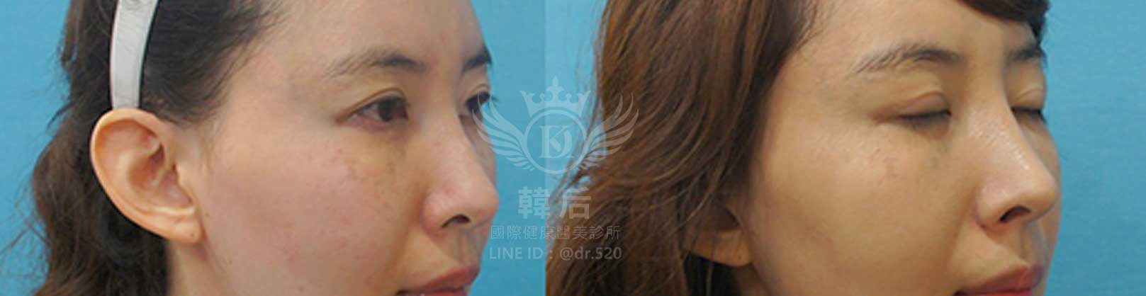 韓后醫美,隆鼻失敗重修,鼻部重修手術,素人真實案例
