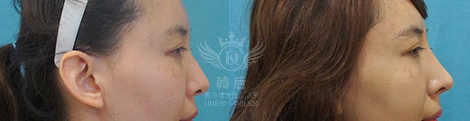 韓后醫美,隆鼻失敗重修,鼻部重修手術,素人真實案例