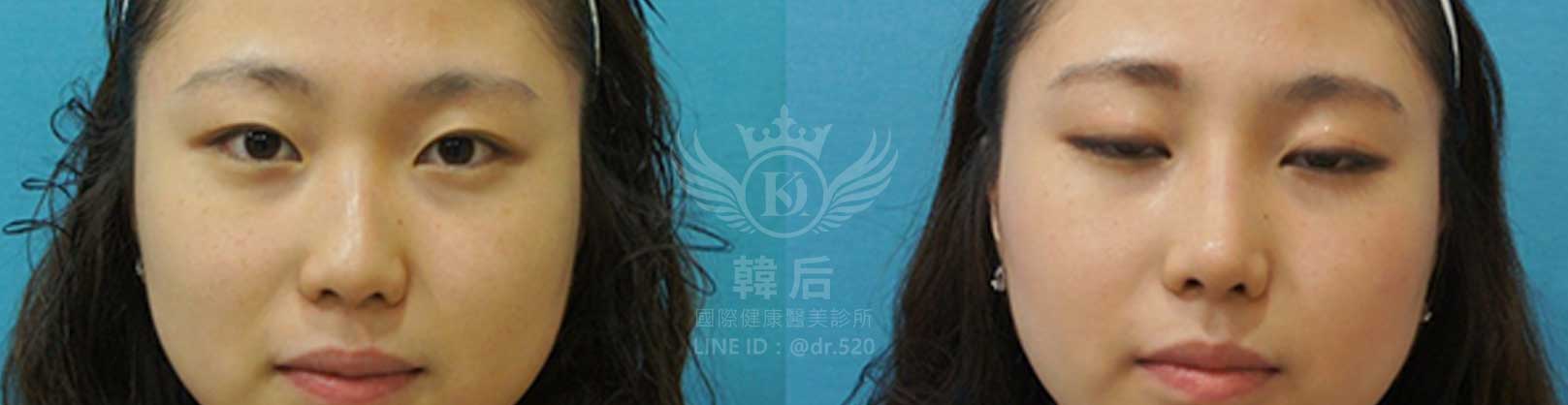 韓后醫美,隆鼻失敗重修,鼻部重修手術,素人真實案例
