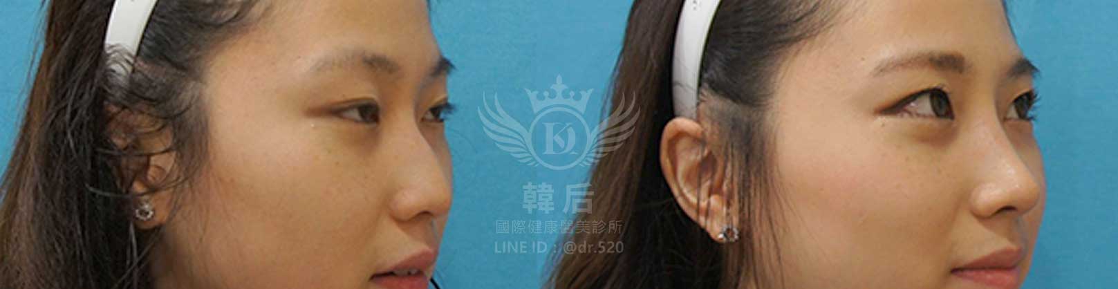 韓后醫美,隆鼻失敗重修,鼻部重修手術,素人真實案例