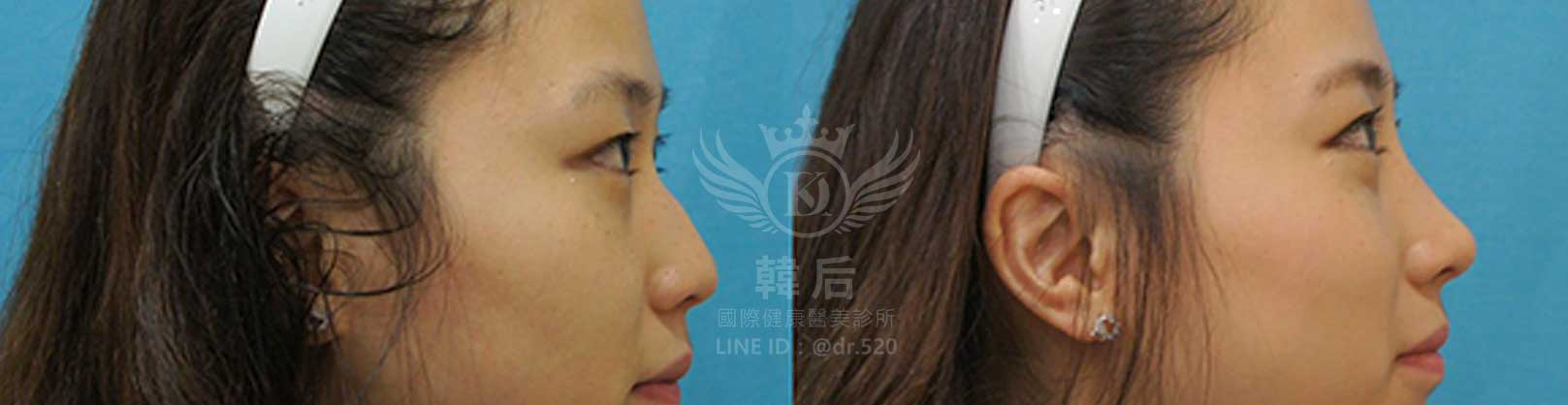 韓后醫美,隆鼻失敗重修,鼻部重修手術,素人真實案例