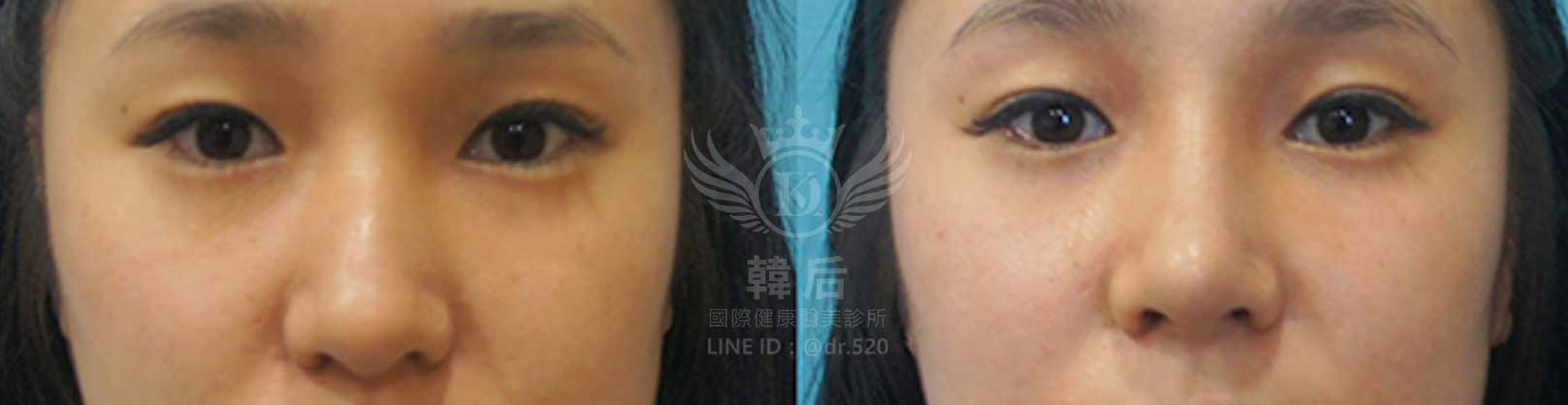 韓后醫美,隆鼻失敗重修,鼻部重修手術,素人真實案例