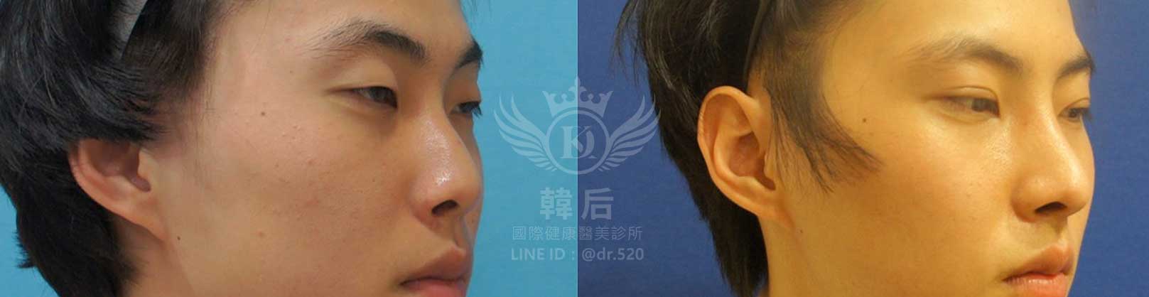韓后醫美,隆鼻失敗重修,鼻部重修手術,素人真實案例