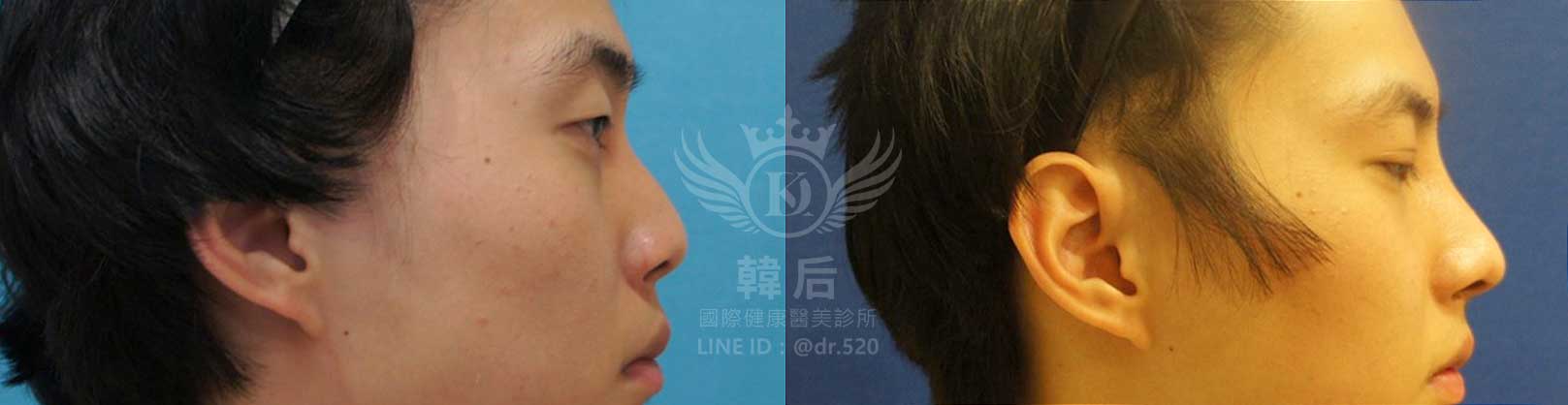 韓后醫美,隆鼻失敗重修,鼻部重修手術,素人真實案例