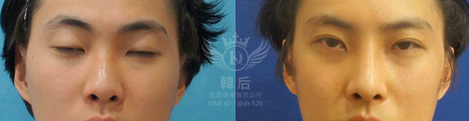 韓后醫美,隆鼻失敗重修,鼻部重修手術,素人真實案例
