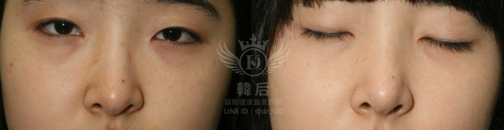 韓后醫美,隆鼻失敗重修,鼻部重修手術,素人真實案例
