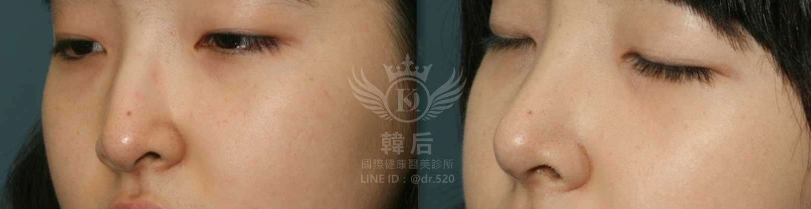 韓后醫美,隆鼻失敗重修,鼻部重修手術,素人真實案例