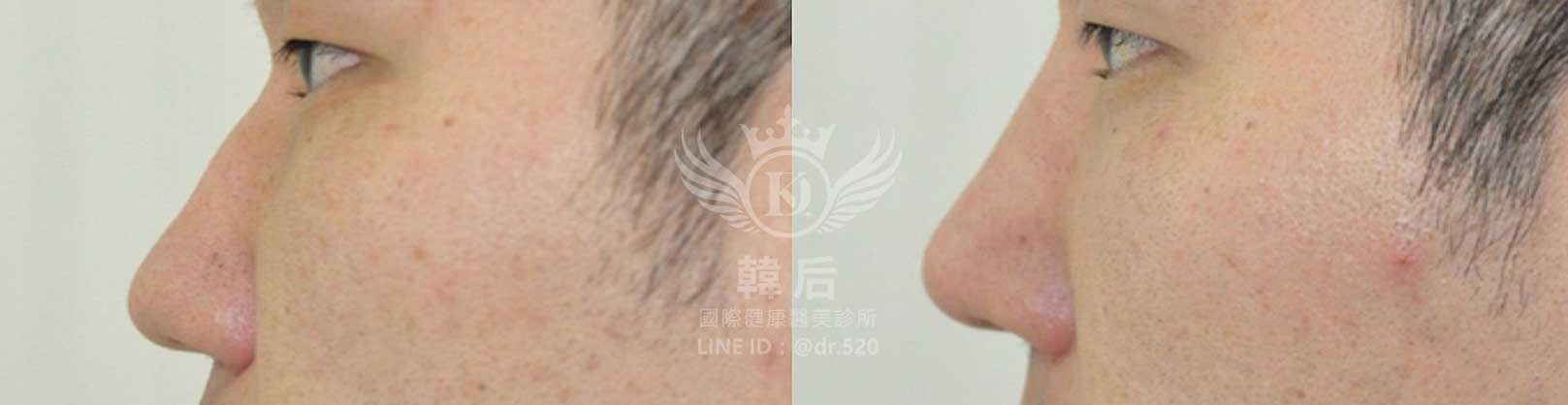 韓后醫美,隆鼻失敗重修,鼻部重修手術,素人真實案例