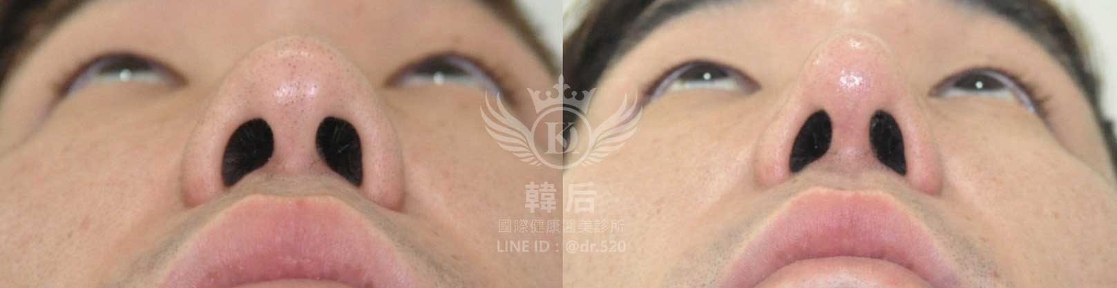 韓后醫美,隆鼻失敗重修,鼻部重修手術,素人真實案例
