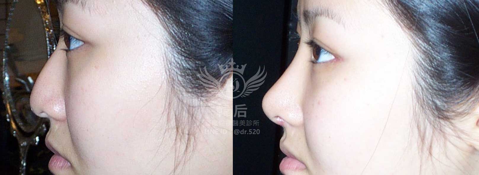 韓后醫美,隆鼻失敗重修,鼻部重修手術,素人真實案例