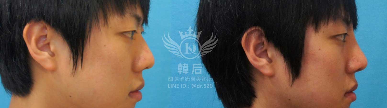 韓后醫美,韓式隆鼻,鼻部手術,大蒜鼻,塌鼻,山根塌,素人真實案例
