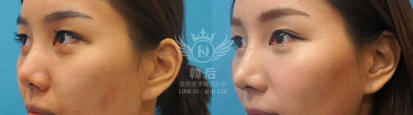 韓后醫美,韓式隆鼻,鼻部手術,大蒜鼻,塌鼻,山根塌,素人真實案例