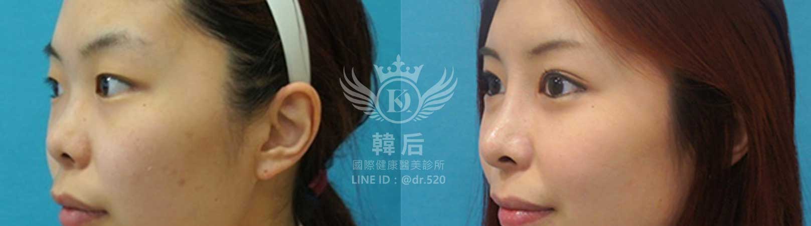 韓后醫美,韓式隆鼻,鼻部手術,大蒜鼻,塌鼻,山根塌,素人真實案例