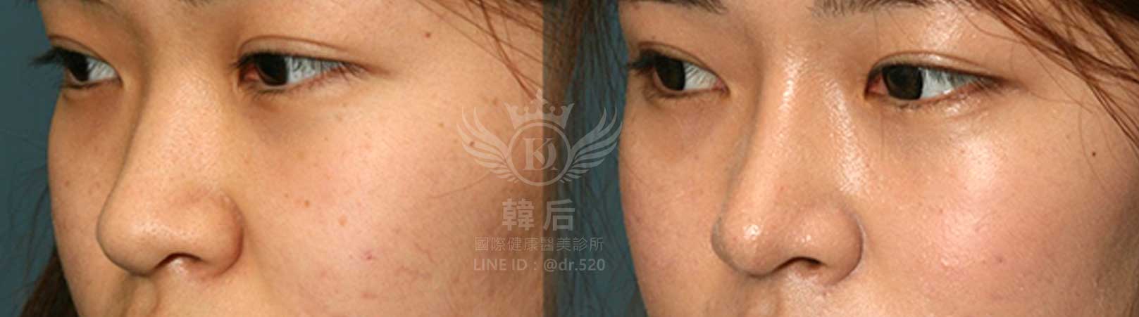 韓后醫美,韓式隆鼻,鼻部手術,大蒜鼻,塌鼻,山根塌,素人真實案例