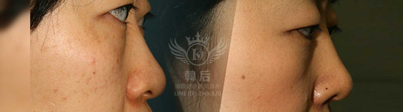 韓后醫美,韓式隆鼻,鼻部手術,大蒜鼻,塌鼻,山根塌,素人真實案例