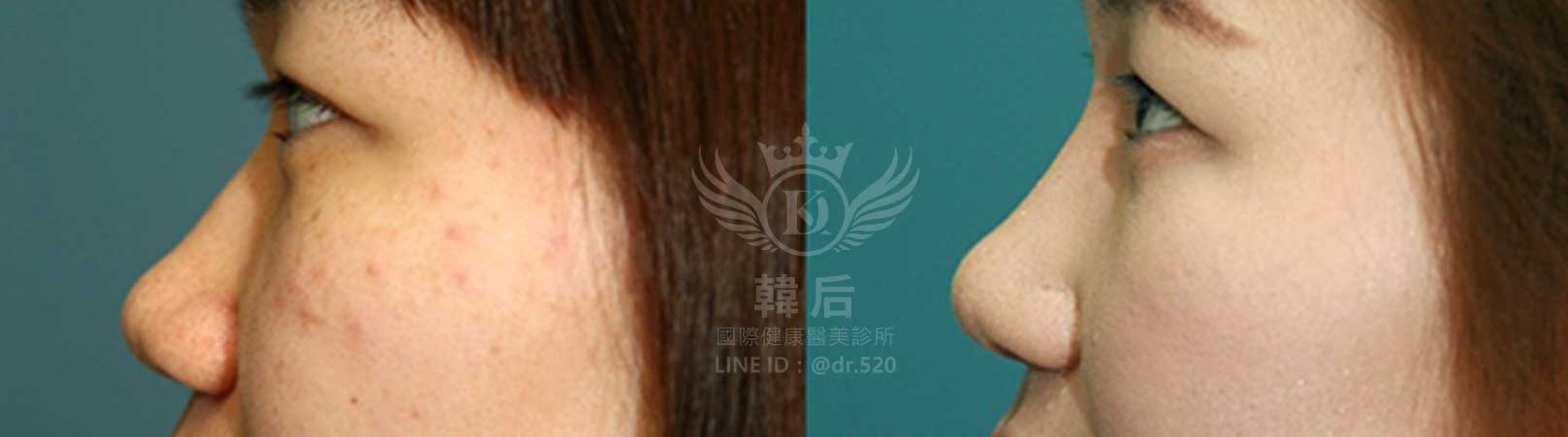 韓后醫美,韓式隆鼻,鼻部手術,大蒜鼻,塌鼻,山根塌,素人真實案例