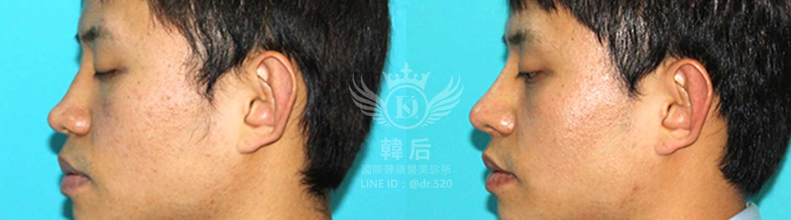 韓后醫美,韓式隆鼻,鼻部手術,大蒜鼻,塌鼻,山根塌,素人真實案例