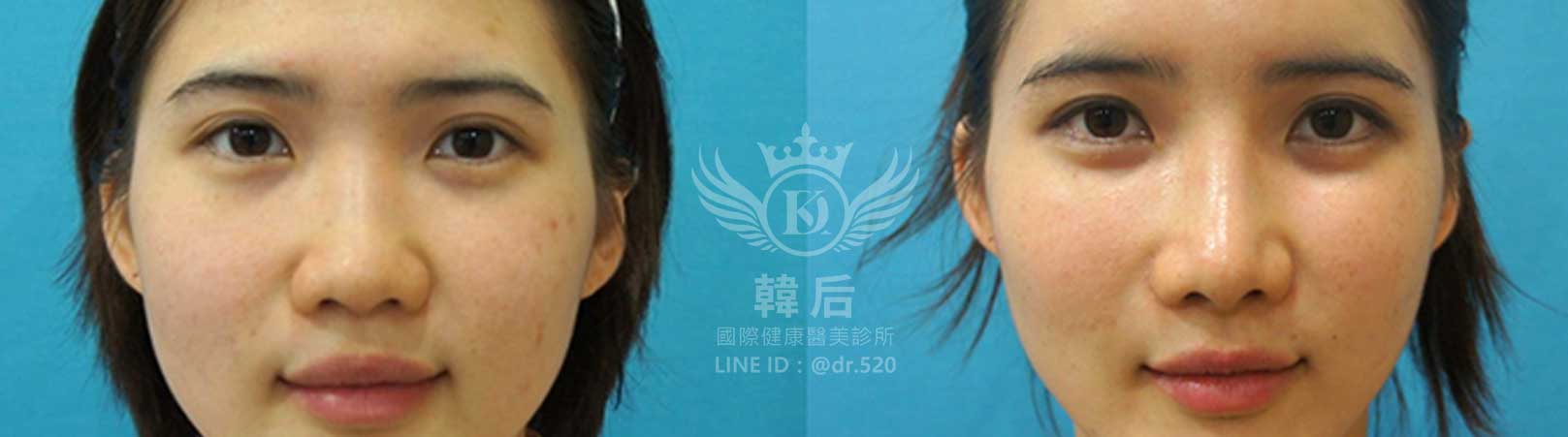 韓后醫美,韓式隆鼻,鼻部手術,大蒜鼻,塌鼻,山根塌,素人真實案例