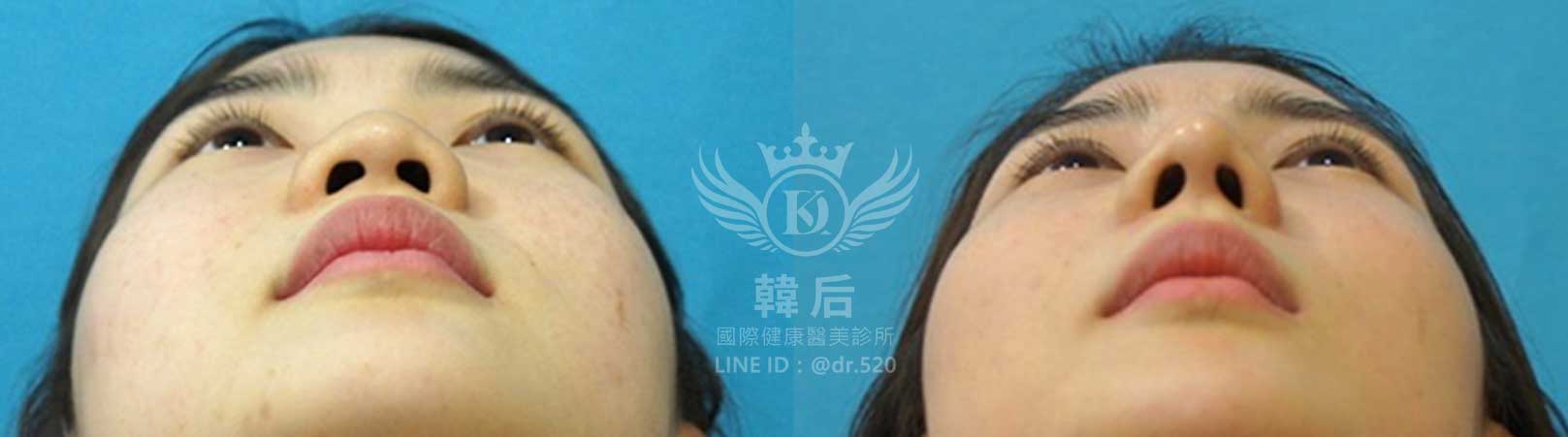 韓后醫美,韓式隆鼻,鼻部手術,大蒜鼻,塌鼻,山根塌,素人真實案例