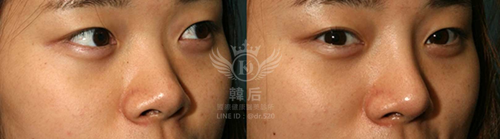 韓后醫美,韓式隆鼻,鼻部手術,大蒜鼻,塌鼻,山根塌,素人真實案例