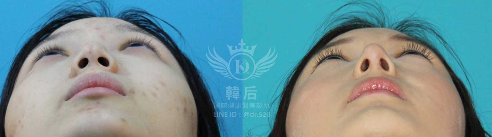 韓后醫美,韓式隆鼻,鼻部手術,大蒜鼻,塌鼻,山根塌,素人真實案例