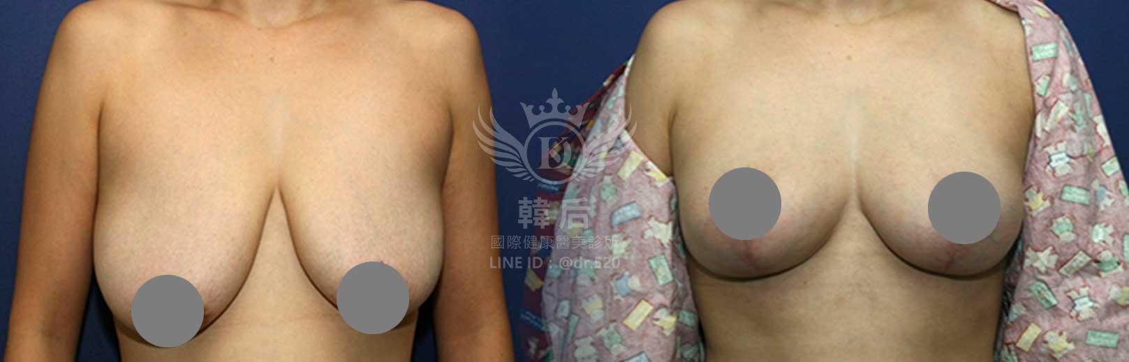 韓后醫美,隆乳,重修乳房,重修假體義乳,縮乳,胸部提升,素人真實案例
