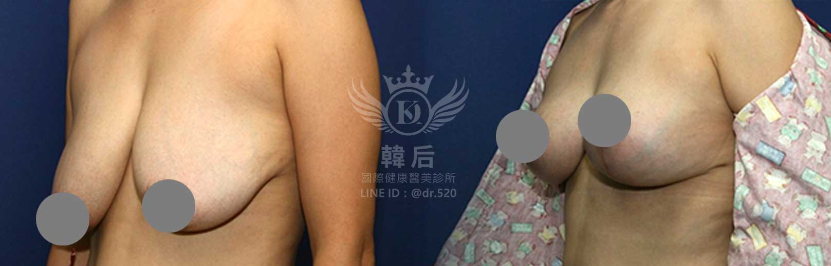 韓后醫美,隆乳,重修乳房,重修假體義乳,縮乳,胸部提升,素人真實案例
