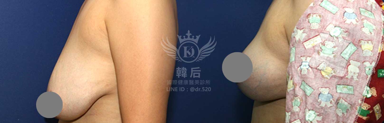 韓后醫美,隆乳,重修乳房,重修假體義乳,縮乳,胸部提升,素人真實案例