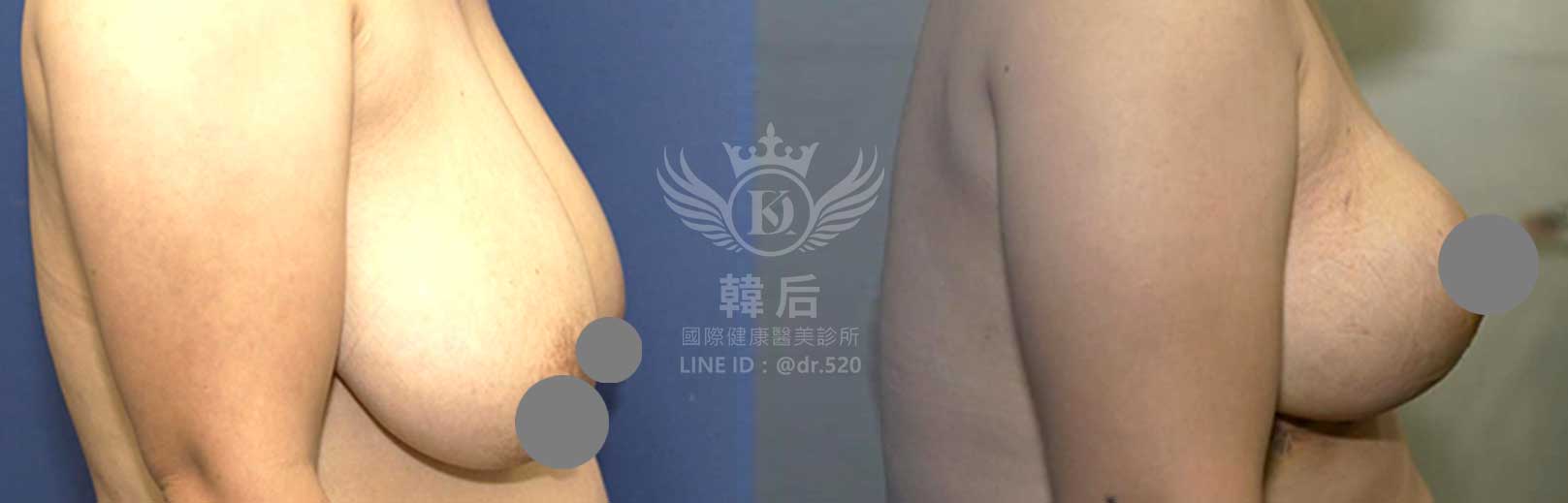 韓后醫美,隆乳,重修乳房,重修假體義乳,縮乳,胸部提升,素人真實案例