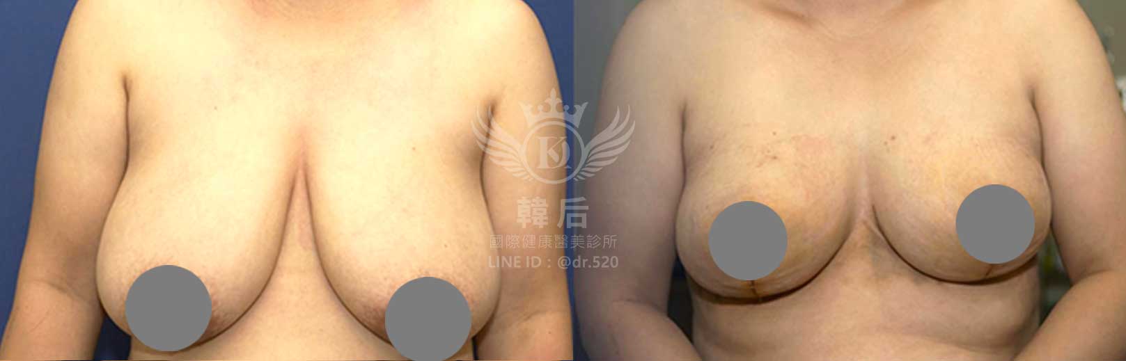韓后醫美,隆乳,重修乳房,重修假體義乳,縮乳,胸部提升,素人真實案例